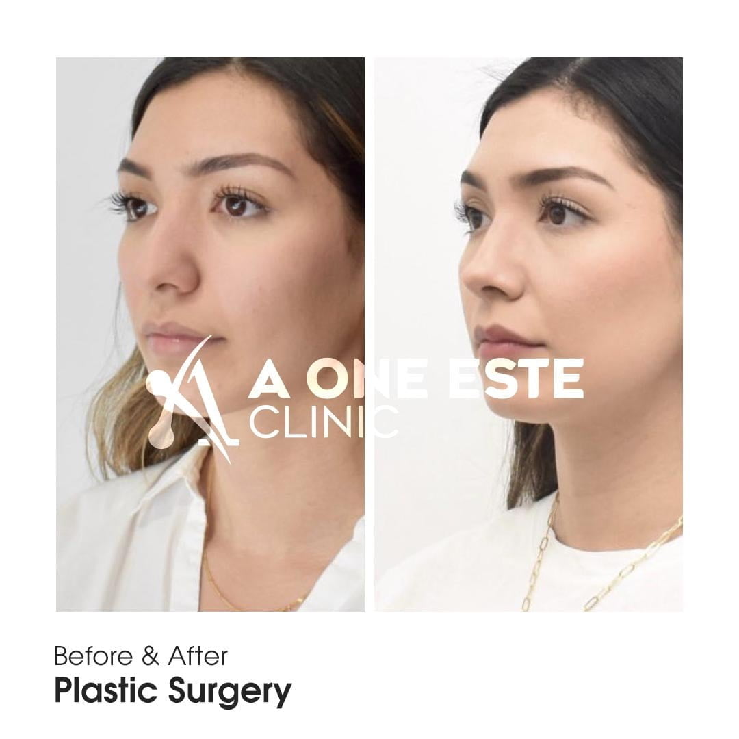 Rhinoplasty Before & After